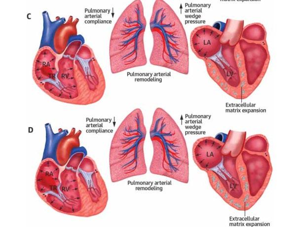 Pulmonale Hypertonie Seite 9