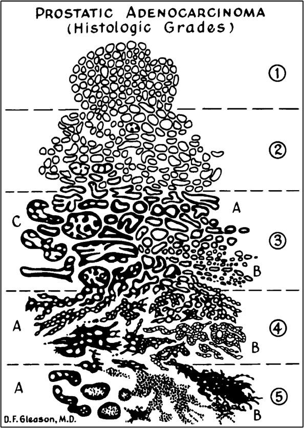 Abbildung 1: Der Gleason Grad nach Donald F. Gleason. Dargestellt sind die morphologi- schen Veränderungen der Drüsenstruktur in den Gleason Graden 1-5.