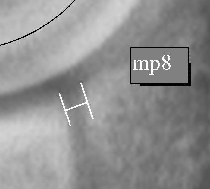 mp8 ist definiert als der Abstand zwischen Radius und Ulna an deren gemeinsamer Gelenkfläche.