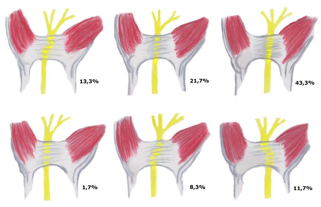 Bezüglich seiner Lage zum Retinaculum befindet sich der N. medianus in 43.3% radial von dessen Mittellinie, in 21.7% direkt unter dessen Median und in 1.7% der Fälle ulnar davon.