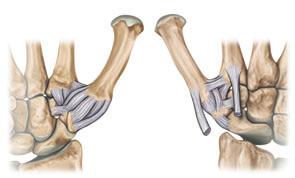 Anatomie und funktionelle Anatomie der Hand Lig. intermetacarpale Lig. intermetacarpale dorsale Lig. trapeziometacarpale II Abb..50 Die Ligamente des Daumensattelgelenks. Links: Ansicht von dorsal.