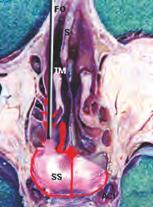 14 Die endoskopisch-anatomische Präparation der Rhinobasis Abb. 32 Makroskopische Anatomie eines Schädelpräparats (Axialschnitt). Transethmoidaler Zugang.