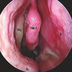 33 Makroskopische Anatomie eines Schädelpräparats (Koronarschnitt). Durch die räumlich beengten anatomischen Verhältnisse ist der Zugang auf direktem intranasalem transsphenoidalen Wege behindert.