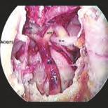 Die endoskopisch-anatomische Präparation der Rhinobasis 19 ACI (c1) III nc IV VI Abb. 55 Endoskopische Detailansicht des Präparats nach Entfernung des Clivus; 0 -Optik, 4 mm Ø. AB = A.