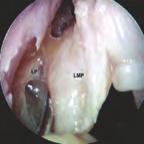 59 Endoskopischer Blick in die rechte Nasenhöhle; 0 -Optik, 4 mm Ø. Es ist die Fortführung der Inzision und der Beginn der Abhebung des Mukoperiostlappens zu sehen.