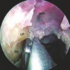 Die endoskopisch-anatomische Präparation der Rhinobasis 21 Abb. 64 Endoskopischer Blick in die rechte Nasenhöhle; 0 -Optik, 4 mm Ø.