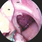 Analog wird ein Mukoperiostlappen freipräpariert, wobei die Inzision auf Höhe der lateralen Nasenwand im hinteren Bereich der Fontanellen beginnt und über den Torus tubarius den Nasopharynx erreicht.