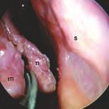 TI = Concha inferior; S = Septum nasi. Abb. 84 Endoskopischer Blick in die rechte Nasenhöhle; 0 -Optik, 4 mm Ø. Die untere Nasenmuschel wird dorsal des Kopfes inzidiert.