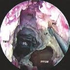 Die endoskopisch-anatomische Präparation der Rhinobasis 31 Abb. 104 Endoskopischer Blick in die linke Kieferhöhle; 45 -Optik, 4 mm Ø. Der N.