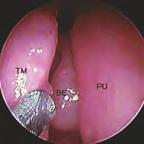 123 Endoskopischer Blick in die linke Nasenhöhle. Subtotale Entfernung der Bulla ethmoidalis.