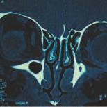 Der Sinus frontalis geht aus der Agger nasi-zelle hervor; die hintere Wand der Stirnhöhle ist von posterior nach anterior und von dorsal nach ventral geneigt; die 1.
