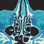 3 Endoskopischer Blick in die linke Nasenhöhle, 30 -Optik, 4 mm Ø. S = Septum nasi; TM = Concha media; AN = Agger nasi; PU = Processus uncinatus; LM = Linea maxillaris Abb.
