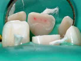 Perforationen zum koronalen Endodont bestehen (c).