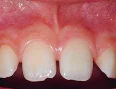 Im Anschluss an die Sicherstellung der Vitalerhaltung des Endodonts wird die definitive restaurative
