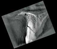 La radiographies conventionnelles (cliché apical [4a] et occlusal [4b]) montrent un trait de fracture dans le tiers moyen de la racine.