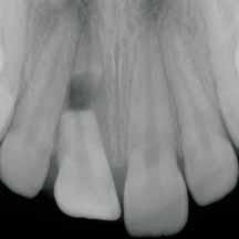 Verletzungen der bleibenden Zähne Teil 3: Therapie der Wurzelfraktur fehlenswert ist auch eine radiologische Überprüfung der Reposition des koronalen Fragmentes vor der Schienung, insbesondere bei