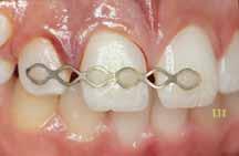 2b) gelingt die manuelle Reposition meist problemlos, und der Zahn wird wiederum mit einer flexiblen Schiene stabilisiert (Abb. 8).