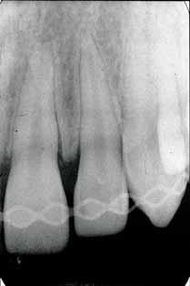 radiculaire dans le tiers cervical de la 11, avulsion de la 21 et fracture amélo-dentinaire sur la 12 (9a).