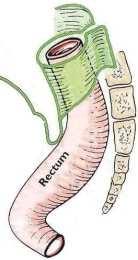 Anatomie des kolorektalen Übergangs Der Übergang wird von proximal am Ende der Taenia anterior (1) und von distal beim ersten