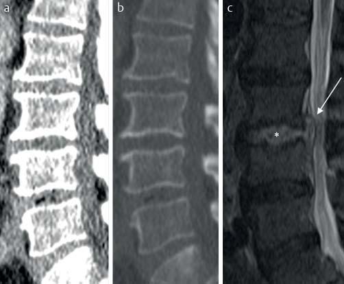 Fig. 3 False-negative NECT for spondylodiscitis of L2 4after spinal intervention in a 50-year-old man.
