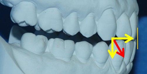 3 8 Magnetresonanztomographie des rechten Kiefergelenks mit totaler Diskusverlagerung ohne Reposition: maximale Interkuspidation Abb.