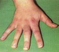 Leitsymptome der Rheumatoiden Arthritis frühe RA: mehr als 2 Gelenke