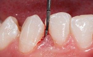 Erste Krankheitssymptome? Ein Besuch beim Zahnarzt schafft Klarheit! Beobachten Sie eine Veränderung an Ihrem Zahnfleisch und/oder Ihren Zähnen? Dann sollten Sie Ihren Zahnarzt aufsuchen.