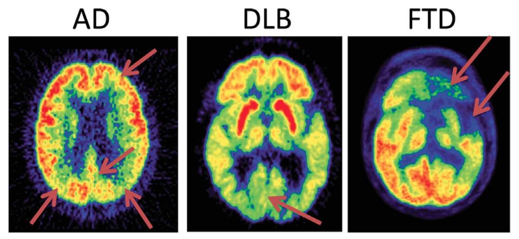 FDG-PET Alzheimer Demenz Demenz mit Lewy Körperchen