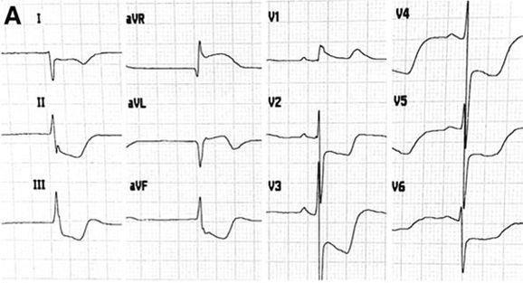 Case: LCM-Stenose