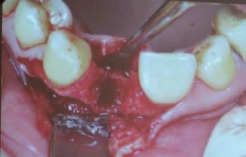 sofortimplantation sollte flapless erfolgen, mit einem gap zur bukkalen Lamelle die mit Kem augmentiert wird, bukkal wird das