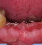 posteriors: Direct restorations on posterior teeth will be covered including indications.