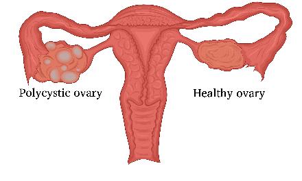 Diagnostik des PCOS PCOS kann auf zwei Arten diagnostiziert werden: 1.) Ultraschallbild Der Gynäkologe kann anhand eines vaginalen Ultraschalls erkennen, ob polyzystische Eierstöcke vorliegen.