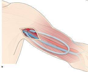 Was sind Extremshunts? em Je I. Cephalicafistel dist. Unterarm, Tabatiere II. a) Basilicafistel Unterarm Cephalicafistel prox.