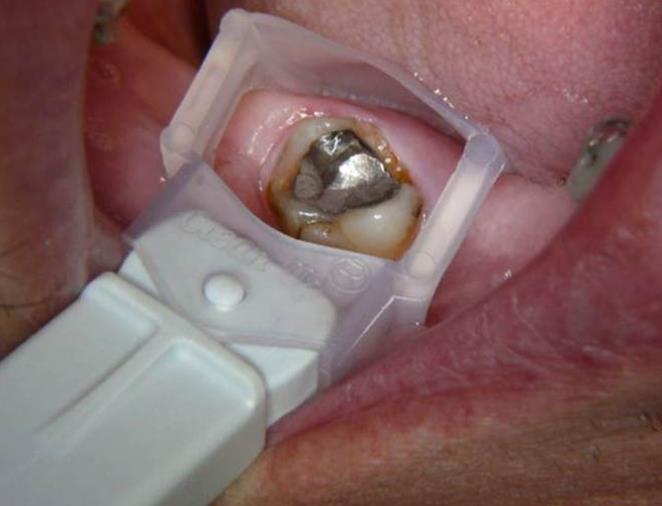 2002 9 Amalgamplomben Entfernt durch amalgamfreie Zahnärztin mit den