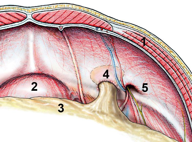 Endoskopische Leistenhernienplastik Bei der Leistenhernie (Leistenbruch) geht es um einen Defekt in der Bauchwand, durch welche Baucheingeweide austreten und entsprechend Beschwerden auftreten können.