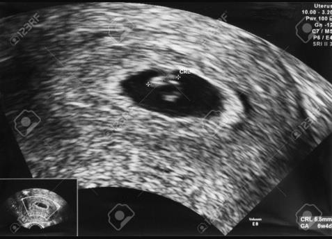 Frühschwangerschaft Sichere Zeichen: o Ultraschall: Eisack,