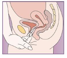 Abbildung 5: FemLoop Vaginalring kann durch Einhaken des Zeigefingers im Ring oder Ergreifen des Rings mit dem Zeige- und Mittelfinger aus der Scheide entfernt werden. 3.