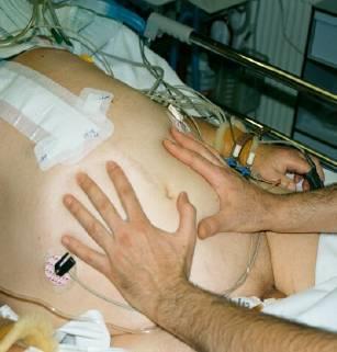 Typical ICU patient Post-laparotomy patient