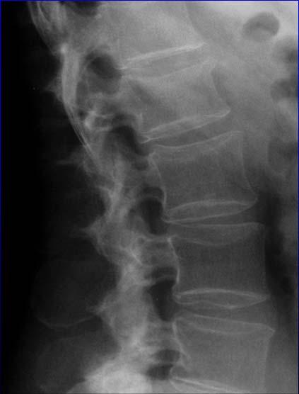 Semiquantitative Visual Grading of Vertebral Deformities SQ Incident Moderate and Severe Fractures 1 3 0 2 Images permission of IOF and ESSR 2004 2004