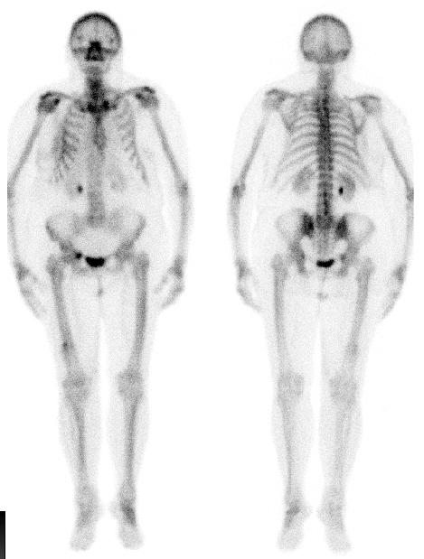 Szintigraphie Abschätzung der Knochendichte nicht möglich keine primär-diagnostische Untersuchung