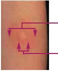 2. ABLESEN DES ERGEBNISSES Das Ergebnis des Hauttests muss 48 72 Stunden nach der Testdurchführung abgelesen werden.