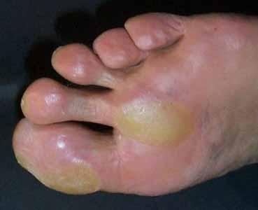 Wunden an den Füßen: Fachpraxen helfen Die konsequente Fußpflege und regelmäßige Fußuntersuchungen sind für Diabetiker notwendig, um Verletzungen der Füße zu vermeiden.