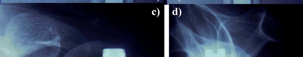 Perforation zweier proximaler Schrauben (Pfeilspitzen) (echt a.p.-aufnahme und skapuläre Y-Aufnahme).