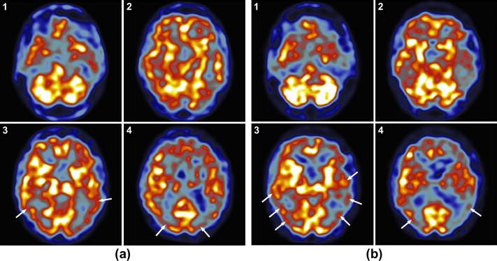 Demenz (M. Alzheimer) [ 99m Tc]-HMPAO-SPECT bei Patient mit milder Demenz zeigt eine reduzierte Perfusion parietal und posterior temporal, typisch für M. Alzheimer (a).