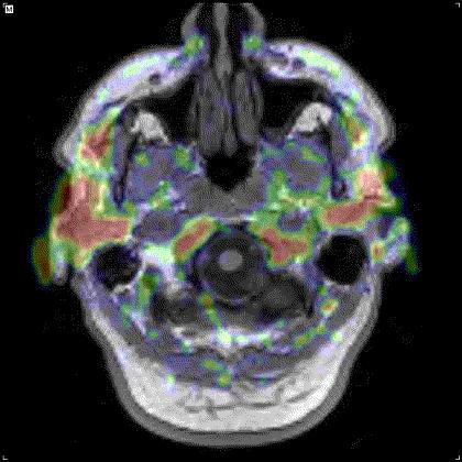 AD β-amyloid Imaging PET-MRI-Overlay - BSP Phase 2A Study - 2.5 SUVR 1.