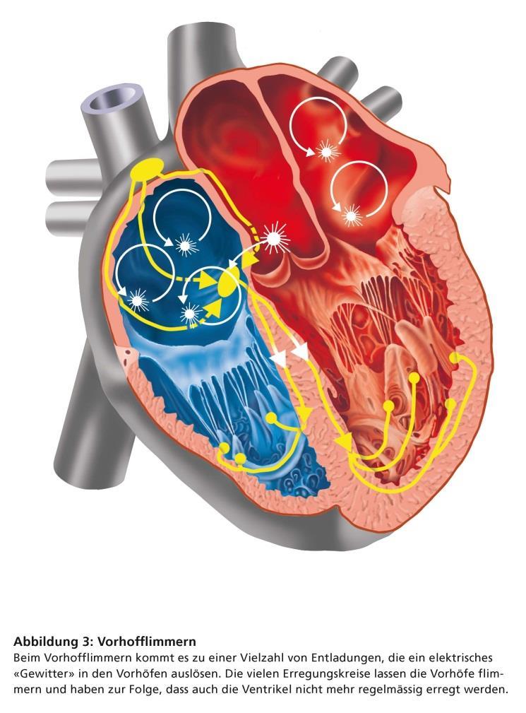 Beispiel 1 Vorhofflimmern: Beim Vorhofflimmern schlagen die Herzvorhöfe nicht mehr regelmässig, sondern zu schnell,