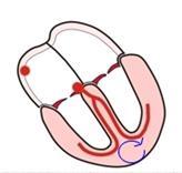 Beispiel 11 Ventrikuläre Tachykardie: Kreisende Erregung aus der Herzkammer, sehr gefährlich
