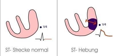 Beispiel 12 STEMI: Verschluss eines Herzkranzgefässes Verletzungsstrom zum betroffenen Myokard hin EKG: In zwei benachbarten Ableitung: