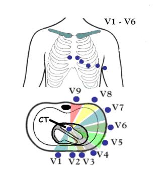 Brustwandableitungen V1: in den 4. ICR rechts neben dem Brustbein V2: in den 4. ICR links neben dem Brustbein V3: zwischen V2 und V4 V4: in den Schnittpunkt des 5.