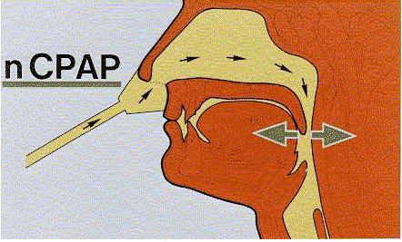 Pneumologische Interventionen ncpap = nasale kontinuierliche Überdruckbeatmung nbipap = nasal bilevel positive airway pressure